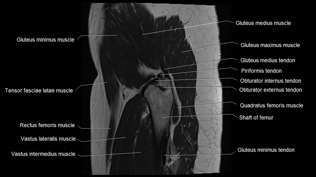 Hip sagittal cross sectional anatomy image 9.webp